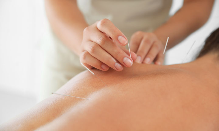 Acupuntura
